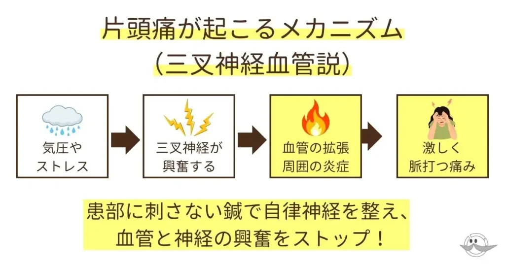 寝不足やストレスによって三叉神経が興奮し、血管拡張と炎症を引き起こす片頭痛のメカニズムと患部に刺さない鍼の図解