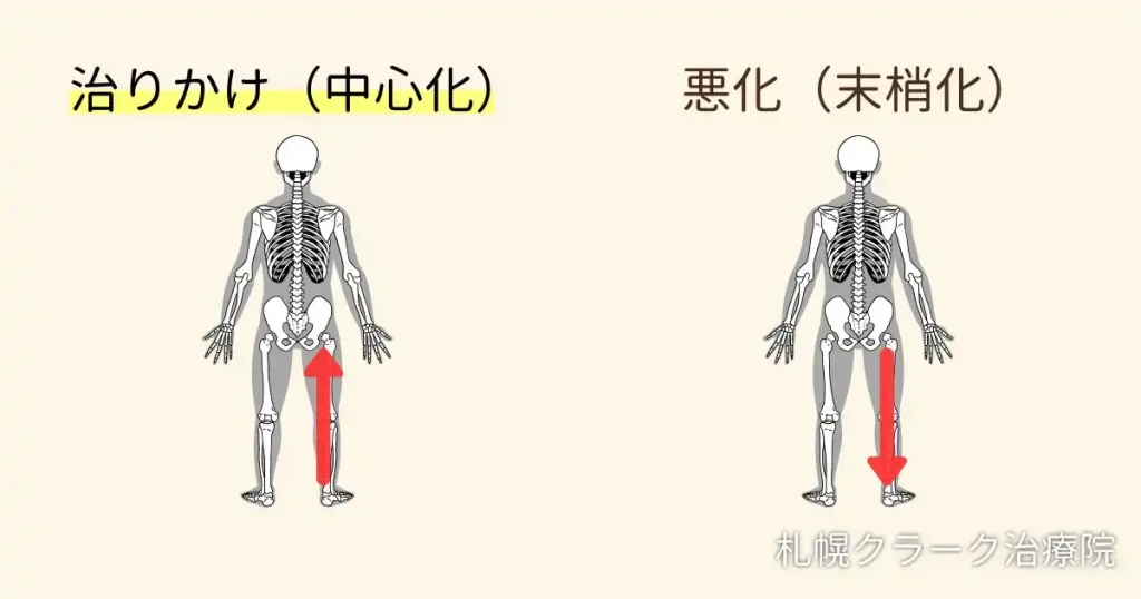 坐骨神経痛の痛みの移動(中心化と末梢化)を示す図解