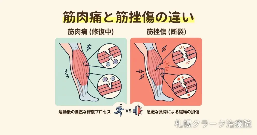 筋肉痛(遅発性筋痛)と肉離れ(筋挫傷)の痛みの違いを比較した図解